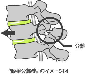 腰椎分離症 イラスト