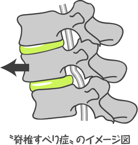 脊椎すべり症