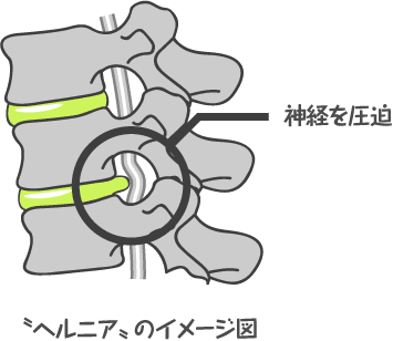 ヘルニアイメージ図