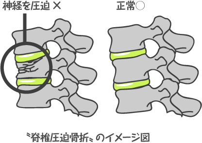 脊椎圧迫骨折 イラスト